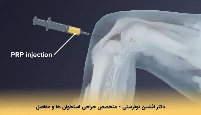 مزایای روش تزریق PRP چیست؟