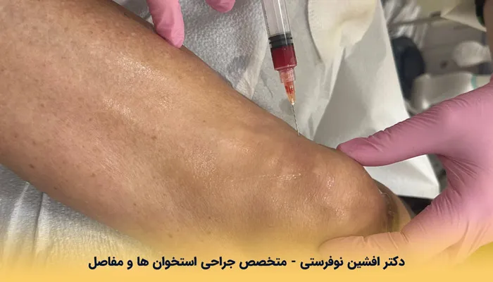 هزینه تزریق PRP برای درمان مفصل
