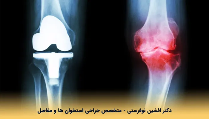 آرتروز زانو چیست