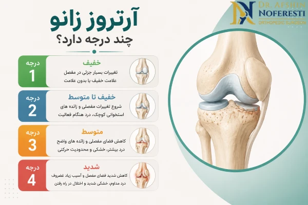 درجات آرتروز زانو