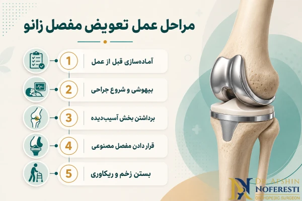 مراحل تعویض مفصل زانو در مشهد
