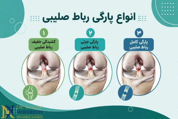 انواع پارگی رباط صلیبی