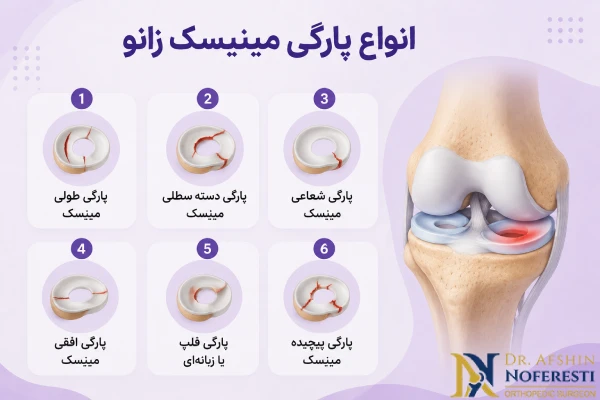 انواع پارگی مینیسک زانو